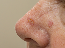 sun-spots-on-nose-ben-0001 sun-spots-on-nose-ben-0001