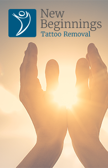 New Beginnings Tattoo Removal