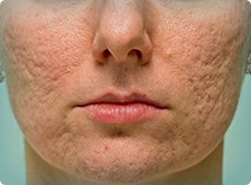 woman-with-acne-scars-ben-001